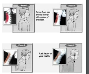 Bahaya Forward Head Posture 2